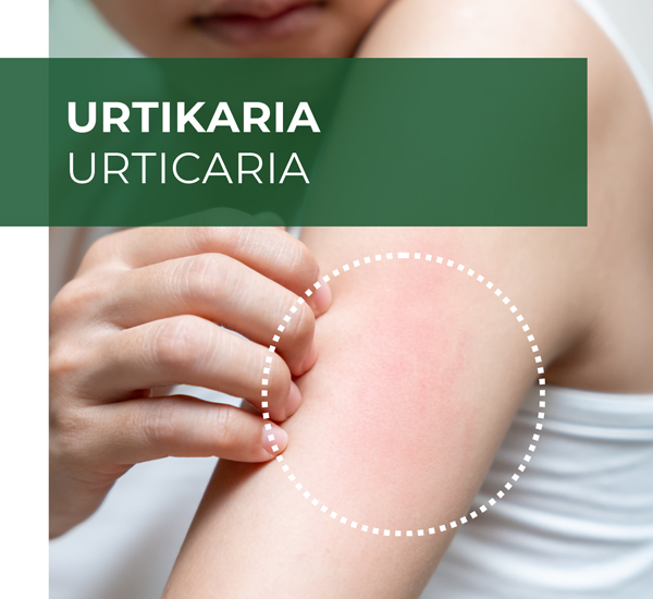 urticaria